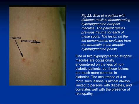 PPT - Diabetic Dermopathy PowerPoint Presentation - ID:460887