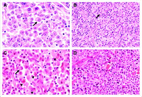 (A) Anaplastic large-cell lymphoma (ALCL), common variant. Predominant ...