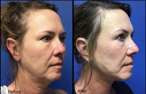 Woman with Face & Neck Lift - Before and After - Carolina Coastal Plastic Surgery