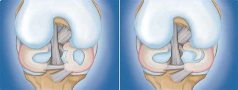 Meniscus Tears | Boston Medical Center