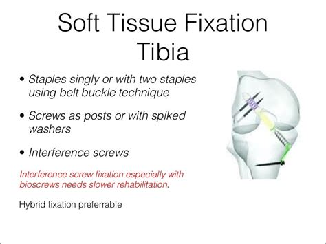 Acl graft fixation options