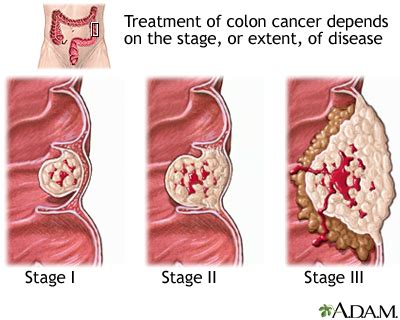 Ca 125 Test For Ovarian Cancer Normal Range