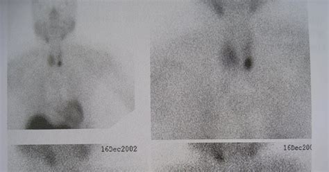 Nuclear Medicine - Another Way Of Learning: PARATHYROID SCAN