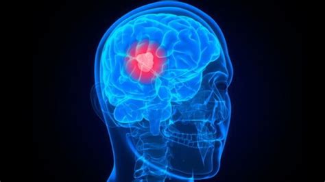 Brain Tumours – Symptoms, Causes, Treatment and Prognosis