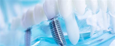 Dental Implant Care: 7 Tips for Looking After Your Implants