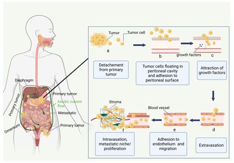 Primary Peritoneal Cancer Symptoms