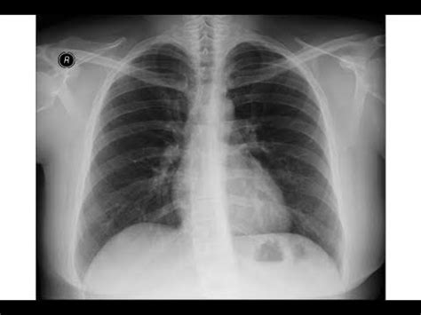 chest x-ray - pneumopericardium - YouTube