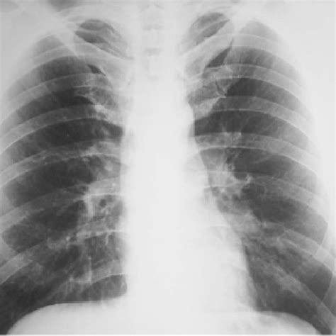 CT scan: A round-shaped formation obstructing the lower lobar bronchus ...