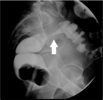 Colonic stricture on barium enema. | Download Scientific Diagram