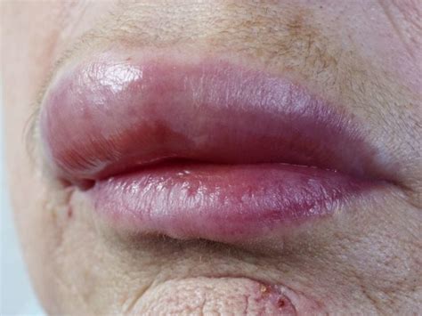 Eczema On Lips Treatments | Lipstutorial.org