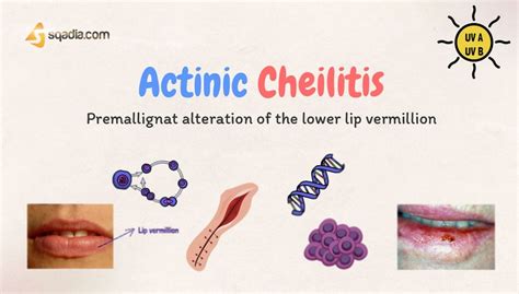 Actinic Cheilitis - Introduction