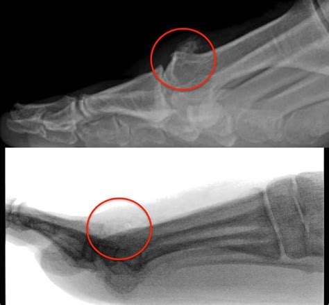 Hallux Rigidus – Arthritis of the big toe - Christopher Miller