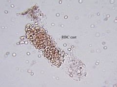 rbc cast in urine | Clinical Significance: RBC casts are the most diagnostic of ... in 2020 ...