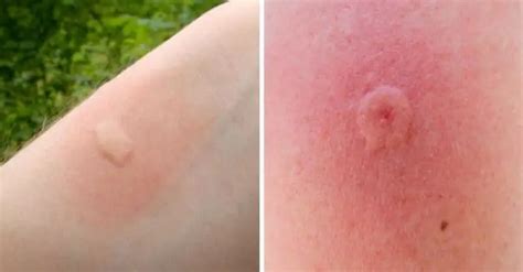 12 Common Bug Bites And How To Recognize Each One