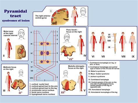 Pyramidal syndrome Symptoms and Treatment | Mediologiest