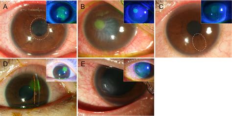 Representative external images of eyes with recurrent corneal erosion.... | Download Scientific ...