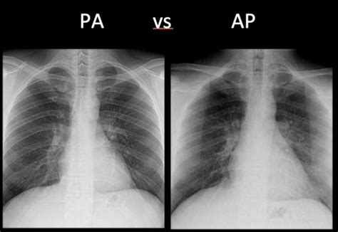 Chest X-Ray Basics: PA vs. AP - dermRounds Dermatology Network