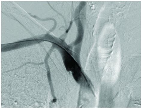 fig4:Inadvertent Subclavian Artery Cannulation: Endovascular Repair Using a Collagen Closure ...