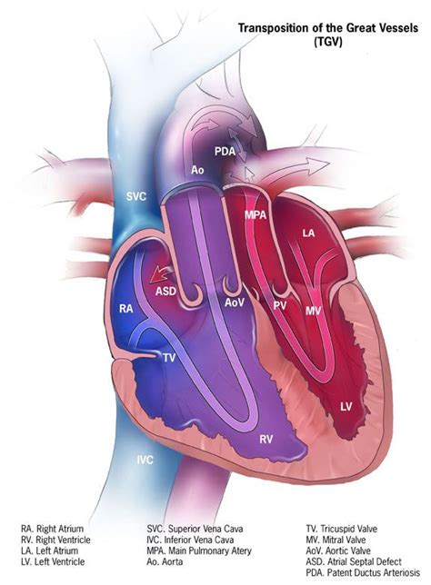 Congenital Heart Defects - dextro-Transposition of the Great Arteries | Congenital heart defect ...