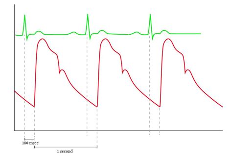 Normal arterial line waveforms - Deranged Physiology