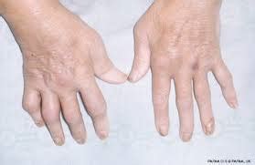 Ichthyosis vulgaris