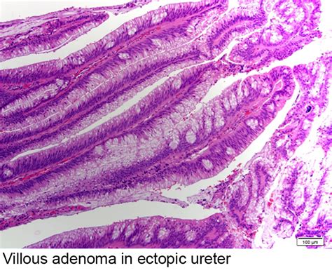 Pathology Outlines - Villous adenoma