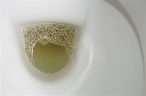 Foamy Urine: Is it a Symptom of a Kidney Disease? | BlackDoctor.org | Urinal, Kidney disease, Foamy