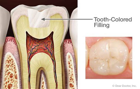 Tooth Cavity Filling