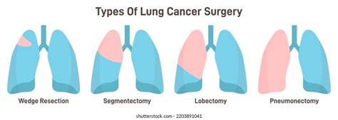 148 Lobectomy Images, Stock Photos, and Vectors | Shutterstock