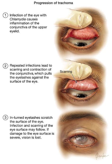 Trachoma | Eye anatomy, Eye facts, Eye health