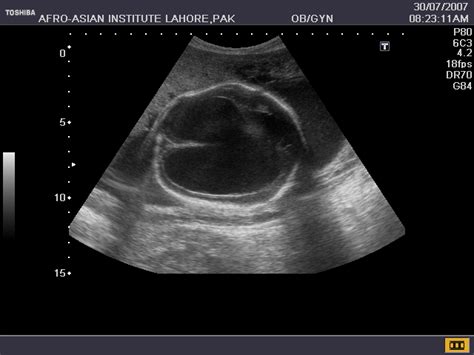 Hydranencephaly | Diagnostic medical sonography, Ultrasound, Sonography