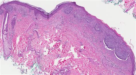 Superficial basal cell carcinoma | MyPathologyReport.ca