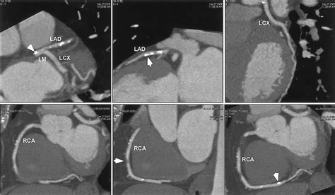 Calcific Coronary Artery Disease - Captions Pages