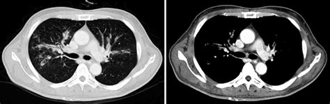 Chest CT shows diffuse peribronchial infiltrates and bronchial wall... | Download Scientific Diagram