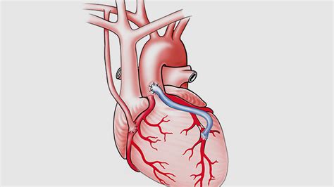 Coronary Artery Bypass Surgery FAQs | Cleveland Clinic