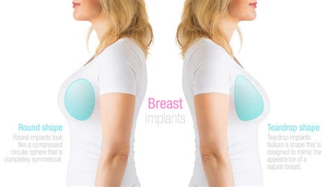 Breast Implant Types - Northern Virginia- Washington DC - The Naderi Center