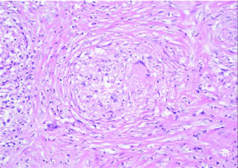 Granulomas composed of epithelioid histiocytes with Langhans type giant... | Download Scientific ...