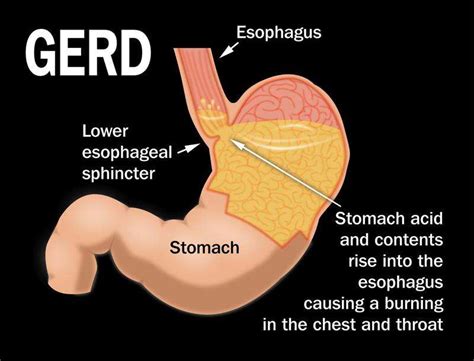 Burning sensation? Sour stomach? Chest pain? You may have GERD – Times ...