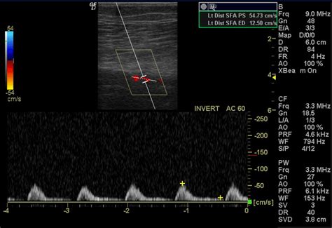 Arterial Duplex Ultrasonography – The Society for Vascular Medicine