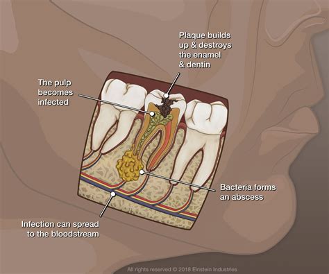 Root Canal Infection Symptoms - Woodinville, WA - Signature Smiles