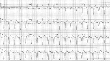 What are the possible presentations of heart failure on electrocardiography?