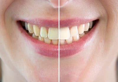 Duluth Teeth Whitening (218) 722-1715 | Teeth Whitening in Duluth MN