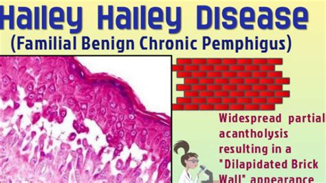 Hailey-Hailey Disease || BENIGN CHRONIC PEMPHIGUS || MINERVA HEALTH ...