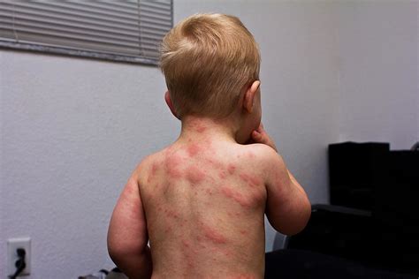 Exanthema subitum - (roseola infantum, sixth disease, thre… | Flickr