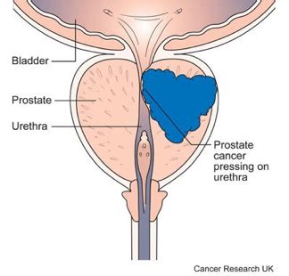 Prostate cancer symptoms - Marie Keating Foundation