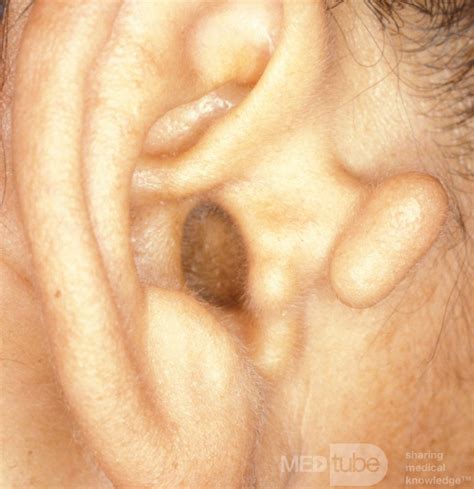 Accessory Auricle • Picture • MEDtube.net