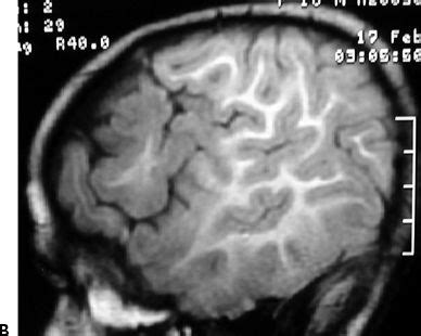 Surgery for Focal Cortical Dysplasias | Neupsy Key