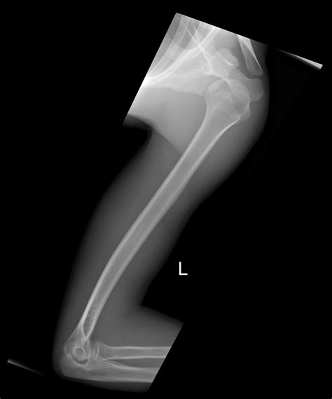 Trauma Humerus X Ray Positioning