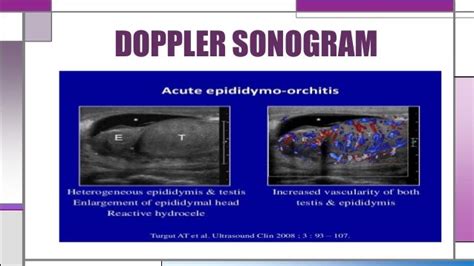 Orchitis & epididymitis