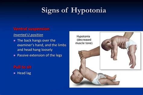 Hypotonia - Cause, Symptoms, Treatment, Exercise